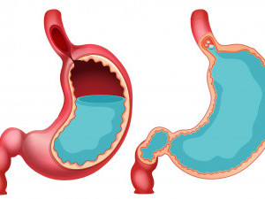 Кислотний виклик: причини та лікування рефлюкс-езофагіту